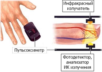 Изображенный на фотографии прибор используется с целью измерения пульса жизненной емкости легких